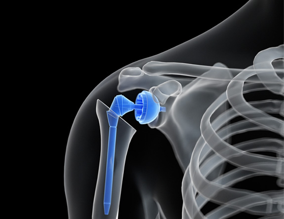 Shoulder Joint Replacement Surgery